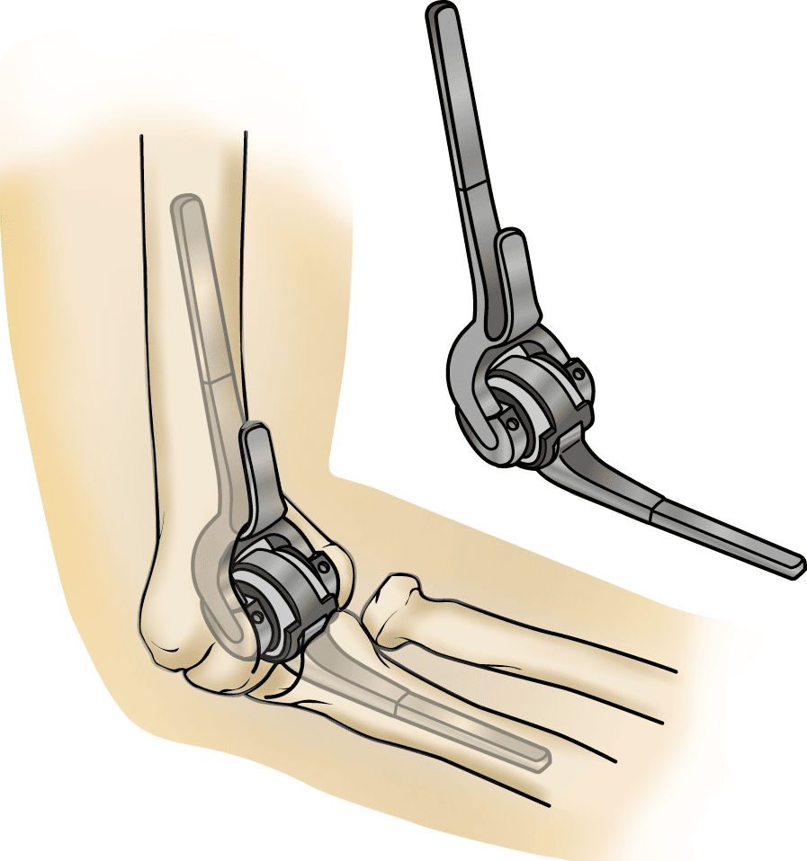 Elbow Replacement Surgery