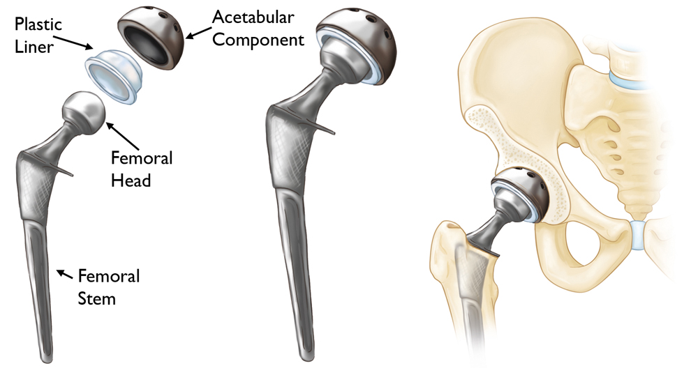 Revision Hip Replacement Surgery