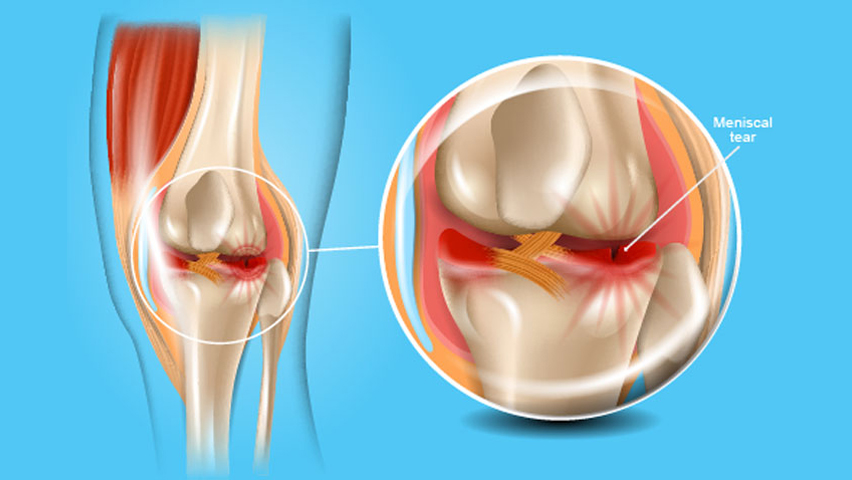 Meniscus Surgery