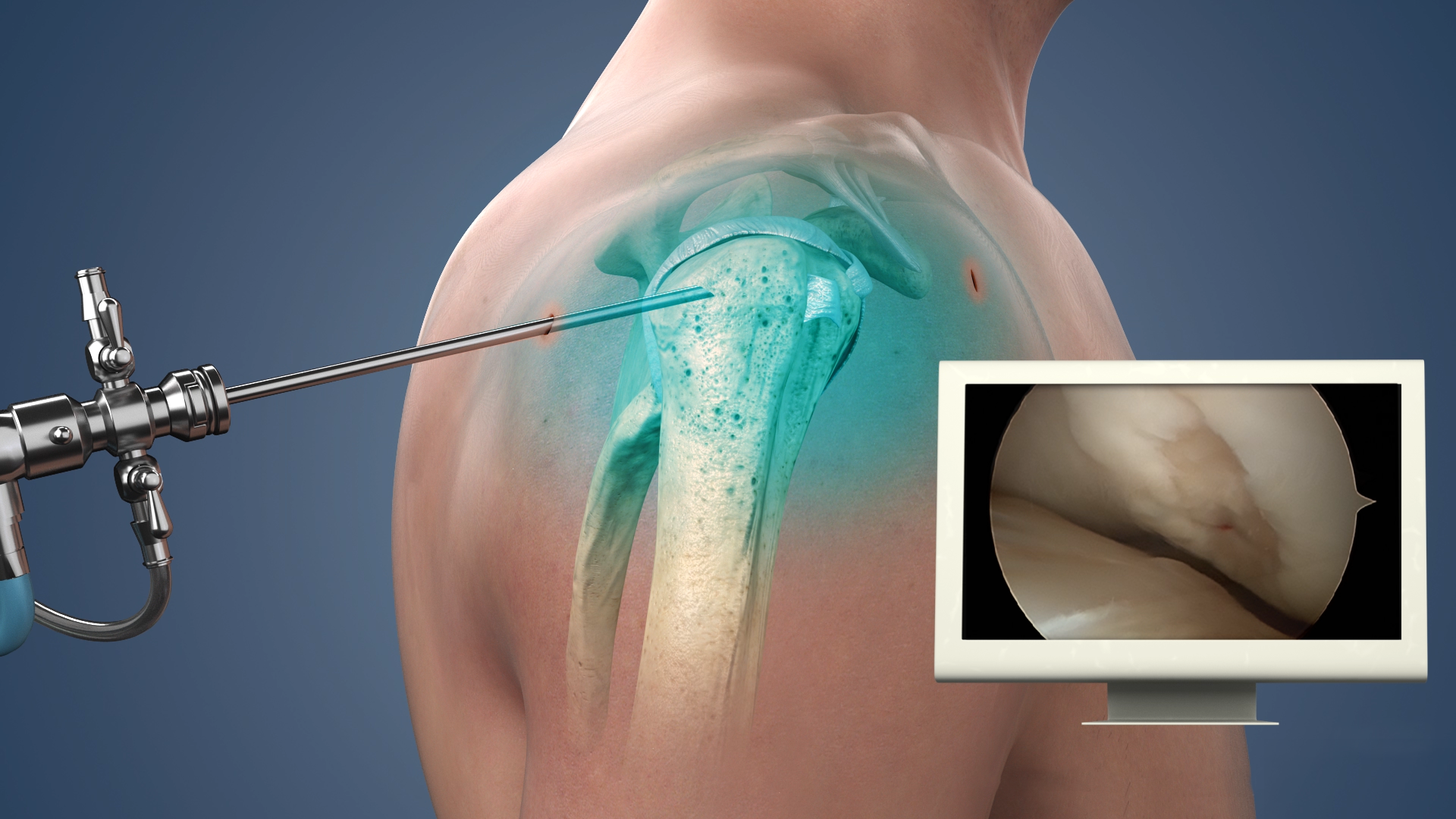 Shoulder Arthroscopic Surgery